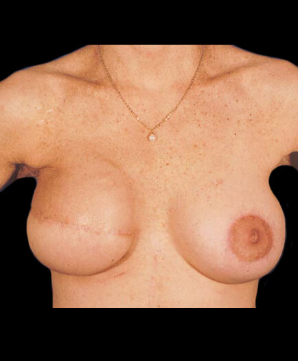 Breast Reconstruction After